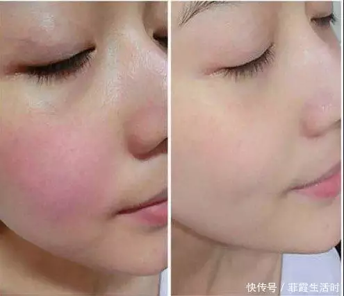 敏感肌高端护肤产品_透明质酸护肤功效_适合敏感肌的温和护肤品