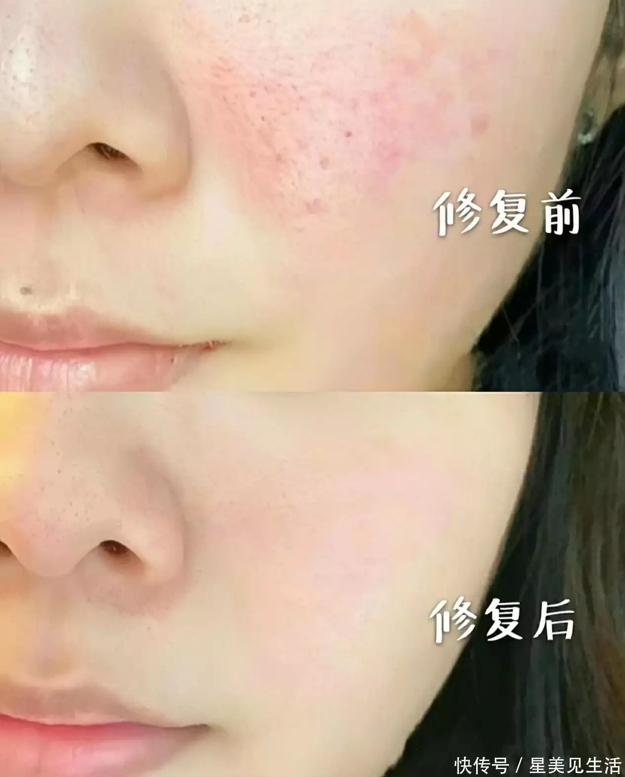透明质酸护肤功效_敏感肌肤护肤品推荐_天然温和敏感肌护理产品