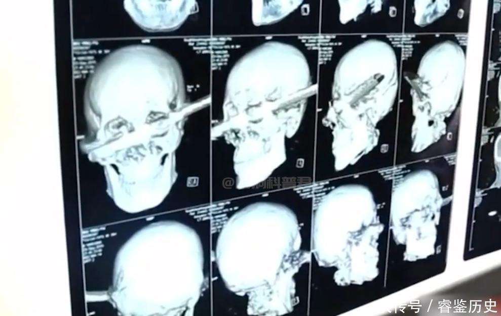 农民工被钢筋横穿太阳穴，左眼凸右眼凹，滞留大脑45小时能活命？