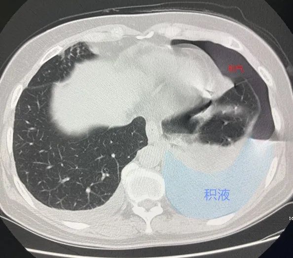  寄生虫|术后要进补？她一个操作感染10种寄生虫