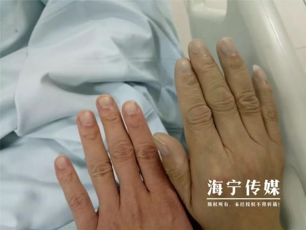 中毒|当心!浙江一女子中毒,就因这道家常菜!指标超正常6.7倍