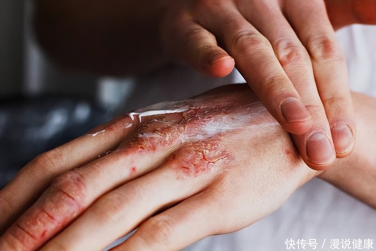 皮肤3种表现警惕是艾滋来袭(错把艾滋病误认为皮肤病？皮肤出现这5个表现，提醒你最好去检测)