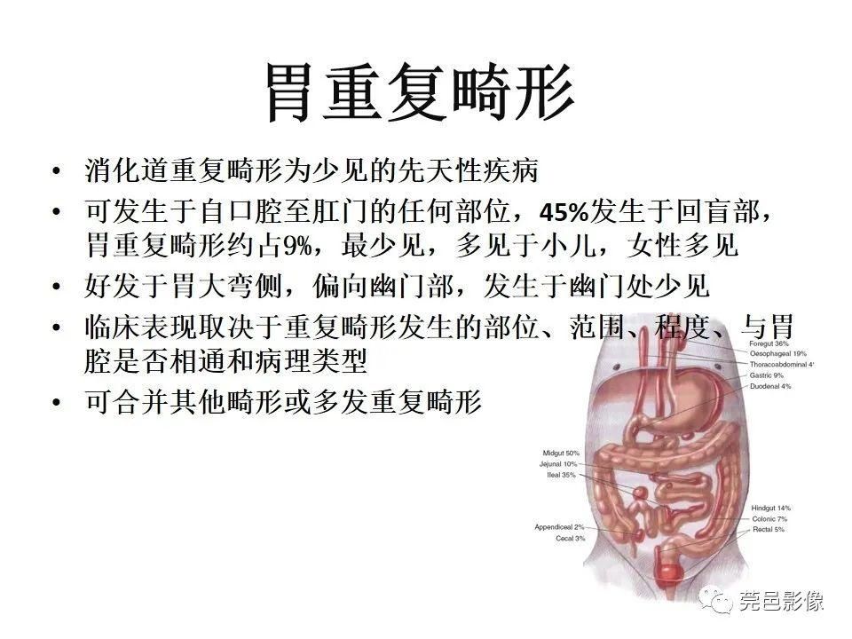 畸形|胃重复畸形CT诊断与鉴别诊断