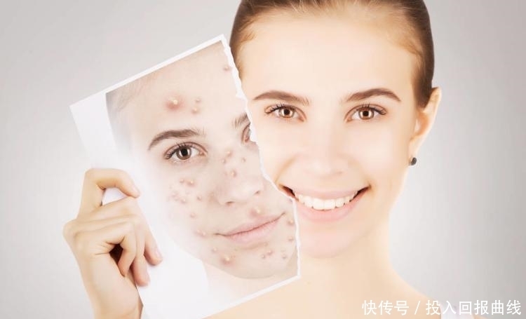  黑头|未成年人长黑头？只需要这样做！