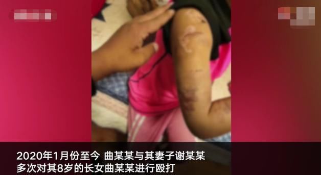 挨打|8岁女童饭店干活被烫伤，爹妈联手每天挨打，面对媒体仍维护父母