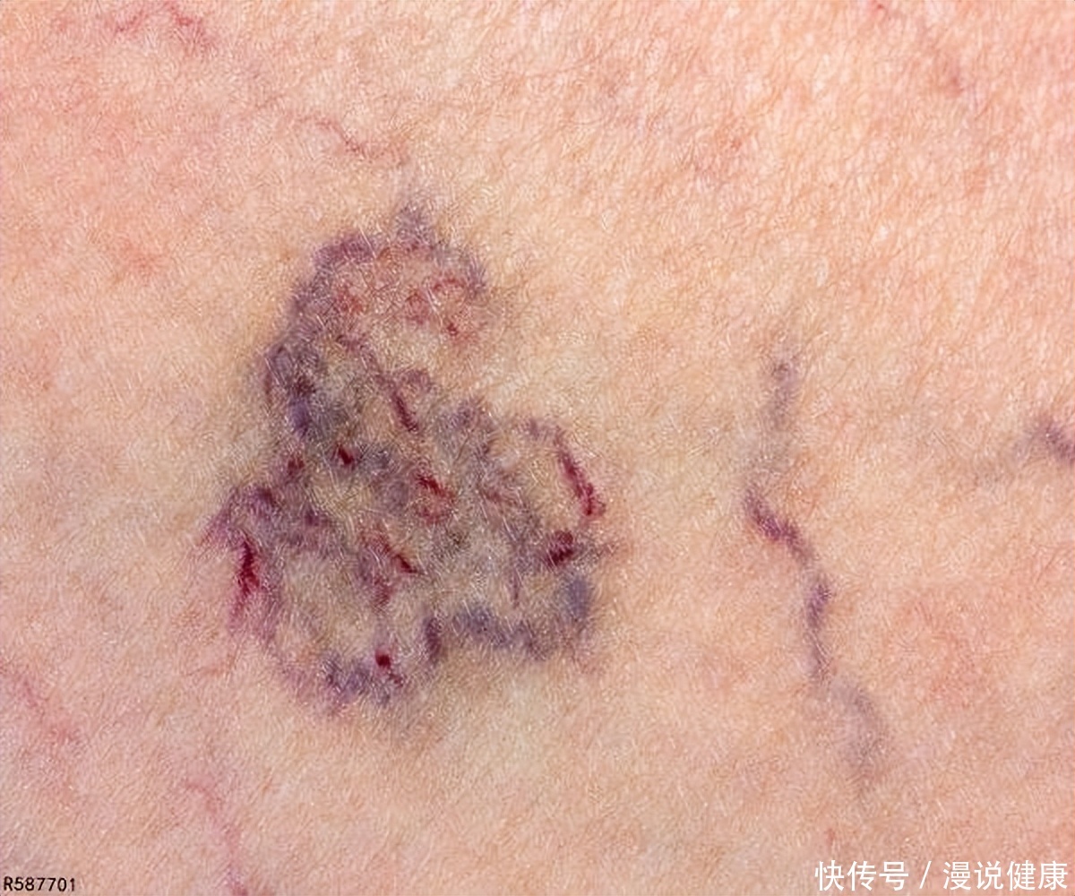 血管粥样斑块怎样清除(血液逐渐老化，是斑块还是血栓？要想清除血管垃圾，可采取这3点)