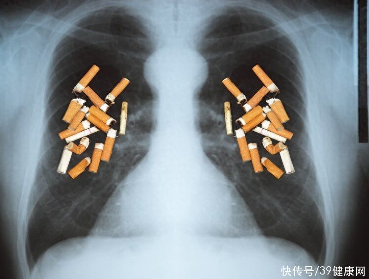 肺癌来临，腿部先知？提醒：双腿出现3个异常，建议尽早检查CT2023