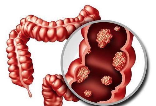  肠道息肉|如何在结肠息肉没有发展成肠癌之前发现并切除