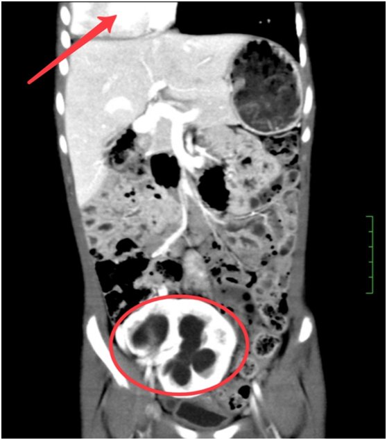 女童|打赏女主播13万后想讨回？法官：不能退！；长沙5岁女童纸尿裤不离身，医院一查惊了！|早安湖南