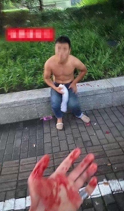  仍在|男子见义勇为阻止性侵被咬掉耳朵 嫌疑人仍在逃