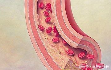 血压高|血压高就是高血压吗?别先着急吃药,要警惕这3种特殊情况