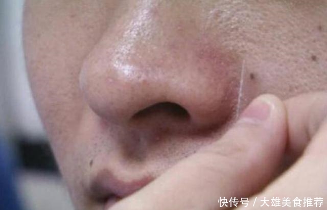 迹象|不管男女生，脸上出现3迹象，说明被螨虫缠上，3招把螨虫一窝端