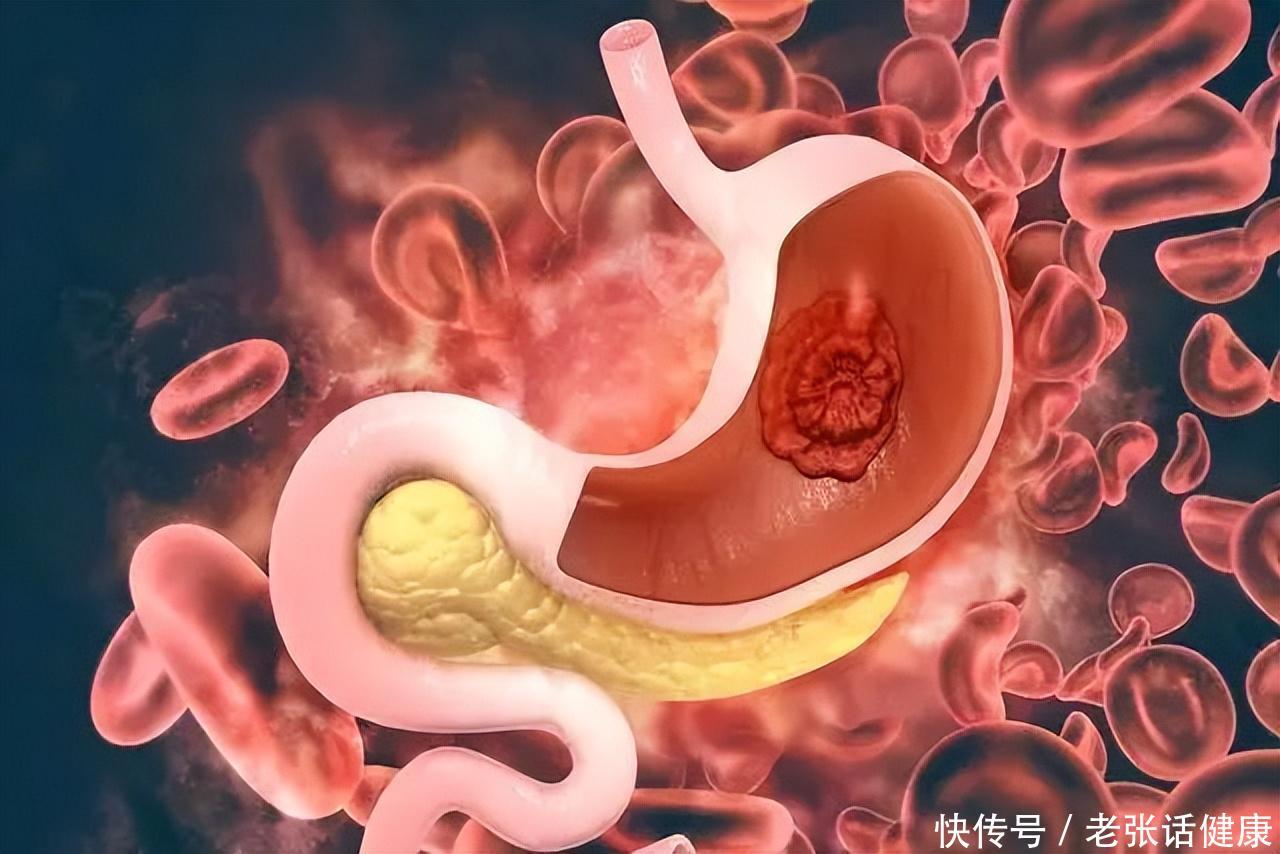 胃病忌口食物有哪些(得了胃病，“忌口”是铁律，提醒：3种食物能不吃就不吃)