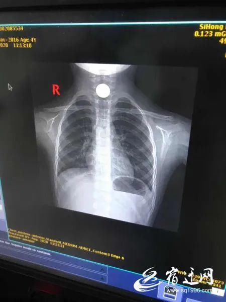  硬币|险！泗洪3岁女孩吞进一枚硬币