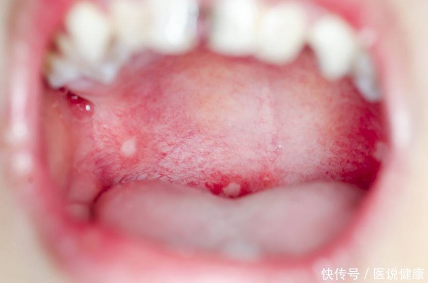 手足口病的预防和处理小常识(手足口病进入高发期，发现时，需及时治疗，这3个方法需了解)