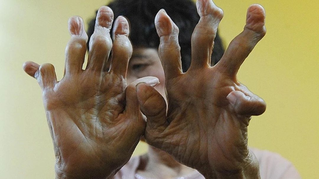  类风湿|风湿与类风湿有什么区别？类风湿的典型症状