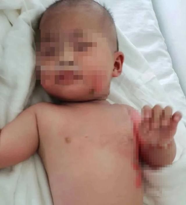  毛巾|揪心！6个月大女婴被烫伤，外公坚持用泡了白酒的毛巾包裹！送医时已休克