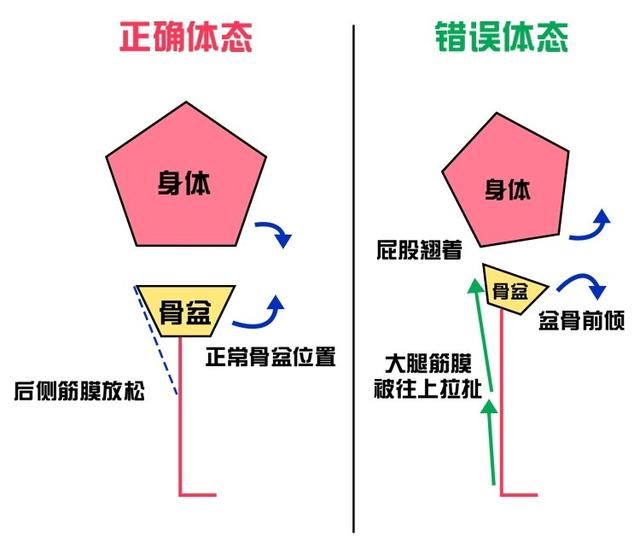  纠正|骨盆前倾危害大，如何自我测试和纠正？看这一篇就够了，男女通用