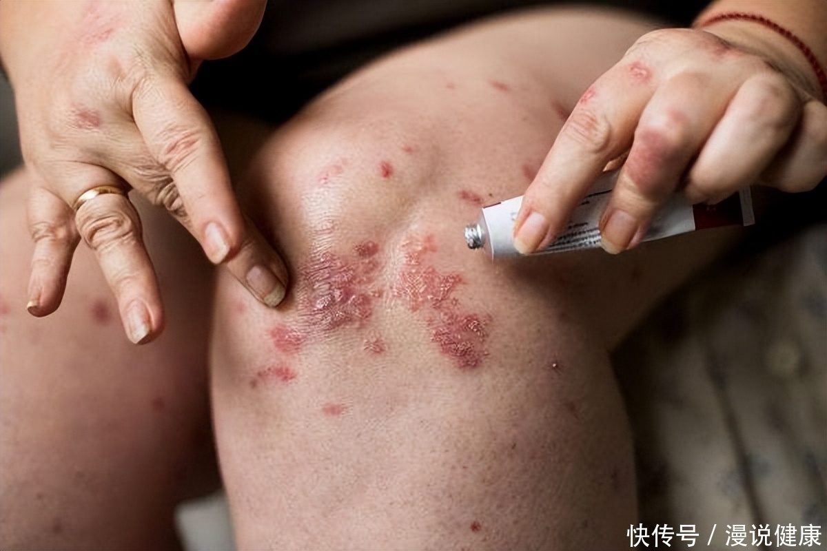 皮肤上长的湿疹是怎么引起的(皮肤长湿疹？身上的这4个迹象，警惕你小心患上这种“不死之癌”)