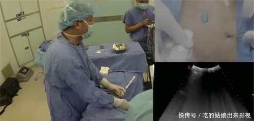 李亚诺|6年前,那个花16万,断骨增高7.2厘米高三男生,如今却后悔了