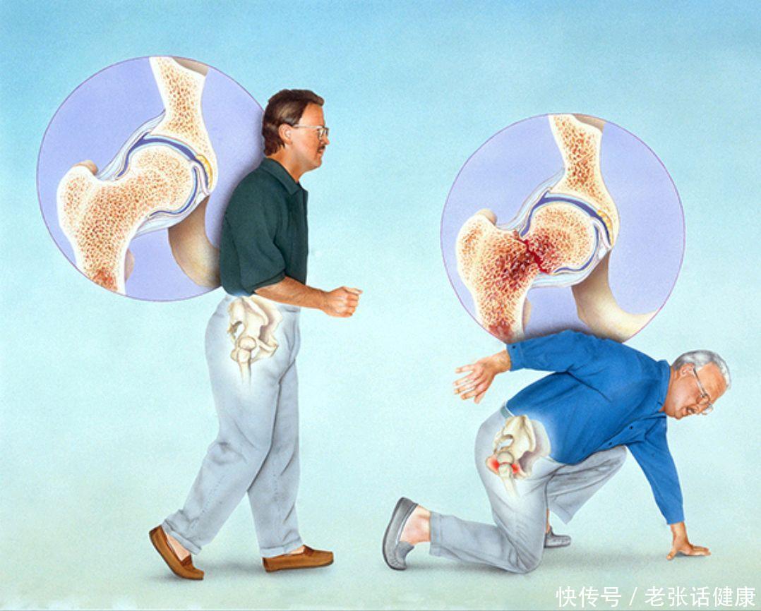 老人经常骨折该吃什么中药调理(老年人为啥容易骨折？50岁后的人，3种食物要舍得吃，或养好骨骼)