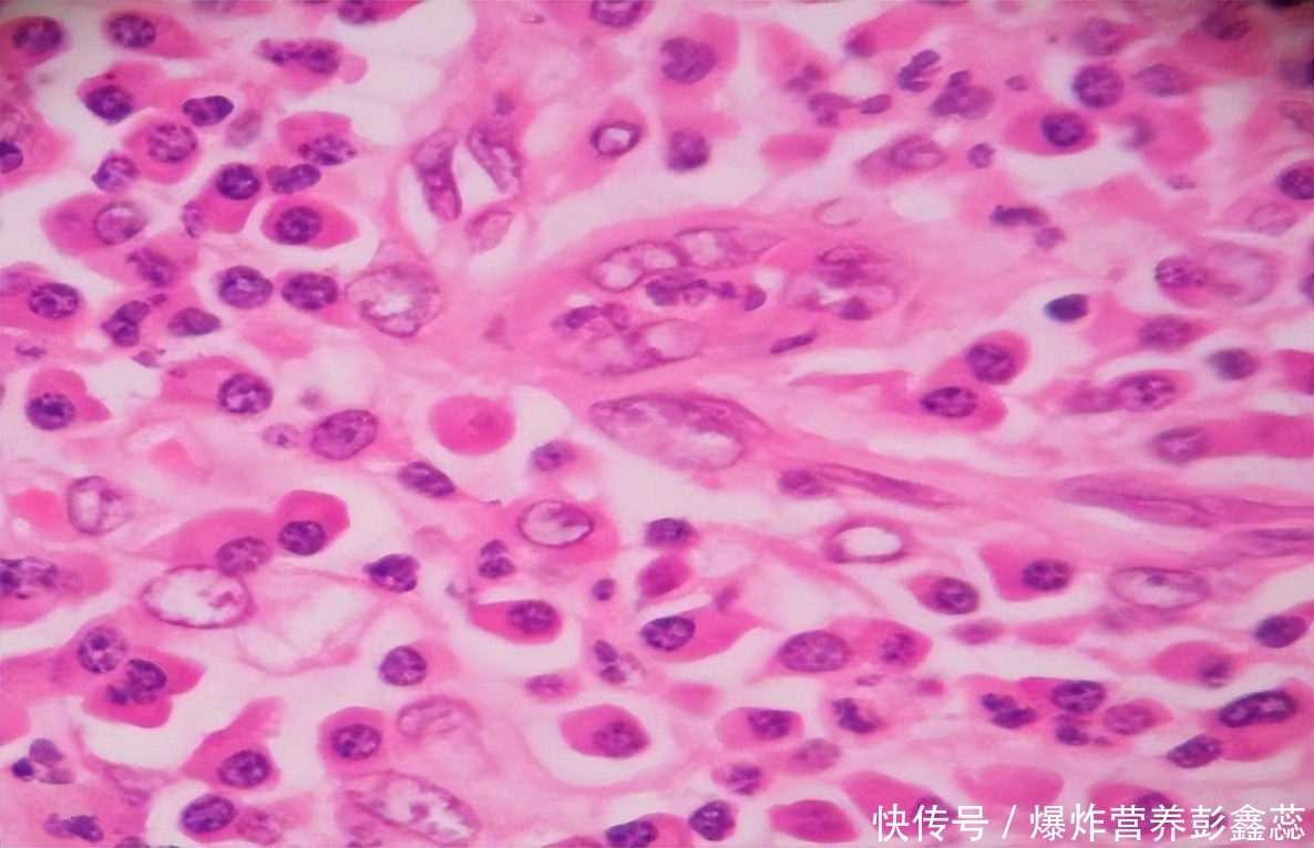 体内有炎症的表现多久能自愈(炎症指数高还是低，可决定一个人的寿命？如何判断体内有炎症)