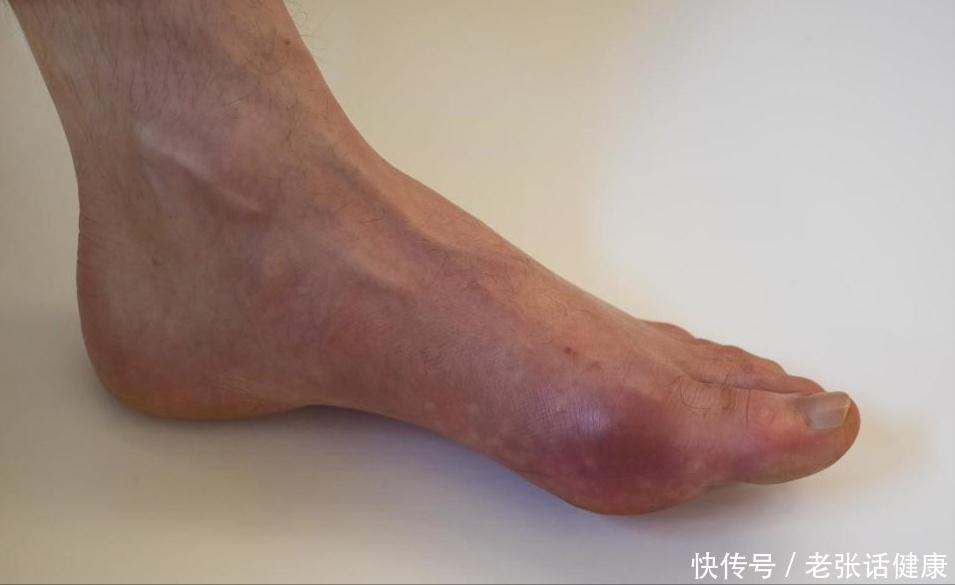 痛风尿酸饮食禁忌及食谱(提醒有痛风的人：常吃6种调味品，或会升高尿酸，能不吃就不吃)