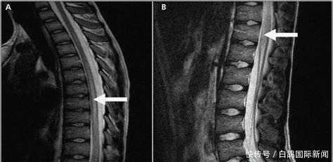 玛莉卡|英国11岁女孩患“百万分之一”机率的罕见病,胸部以下全瘫痪