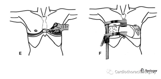  研究|推荐：双侧前开胸切口(Clamshell 切口)的解剖学研究