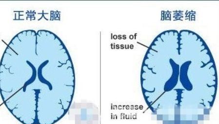 健康|人体健康之额颞叶痴呆