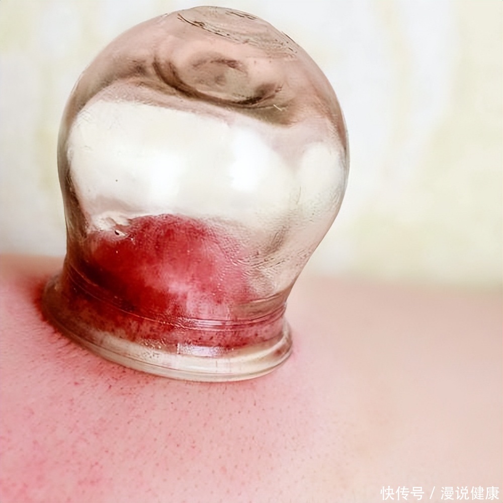 成都大运会拔罐(成都大运会“拔罐”预约火热？拔罐虽好，但对于5类人却不太适合)
