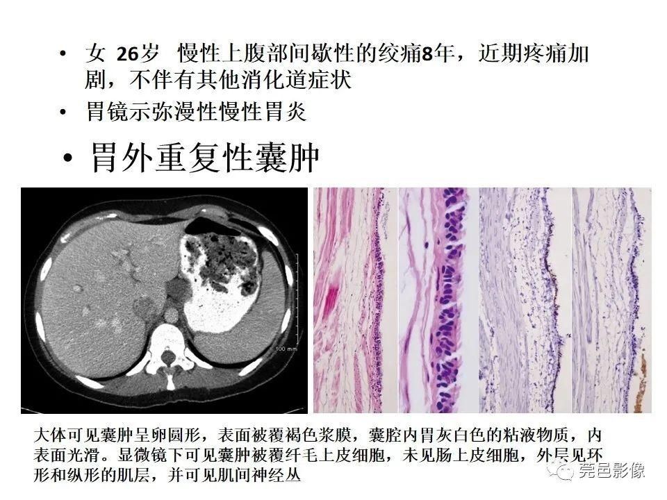 畸形|胃重复畸形CT诊断与鉴别诊断