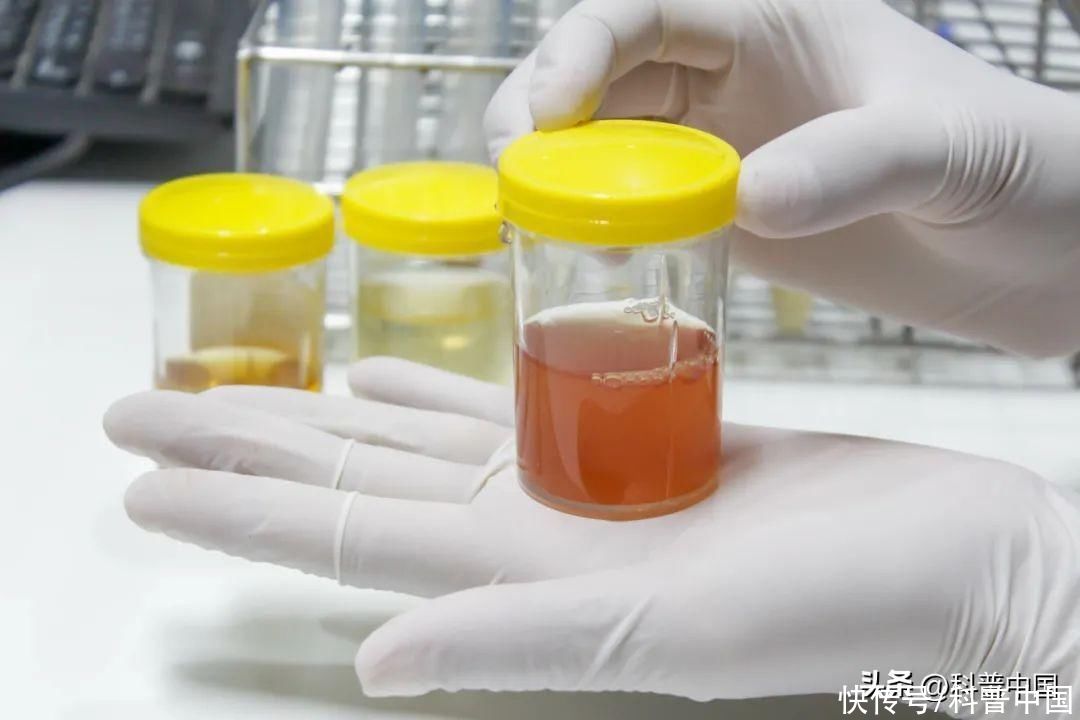 8种尿液颜色预示得了这些病(尿液变色是疾病前兆？关于尿液的 8 种颜色，一文说清！)