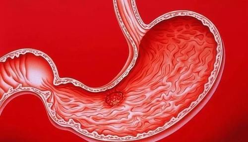 胃病|消化科主任:1种养胃水,连喝30天,清幽门螺杆菌,胃病一扫而光