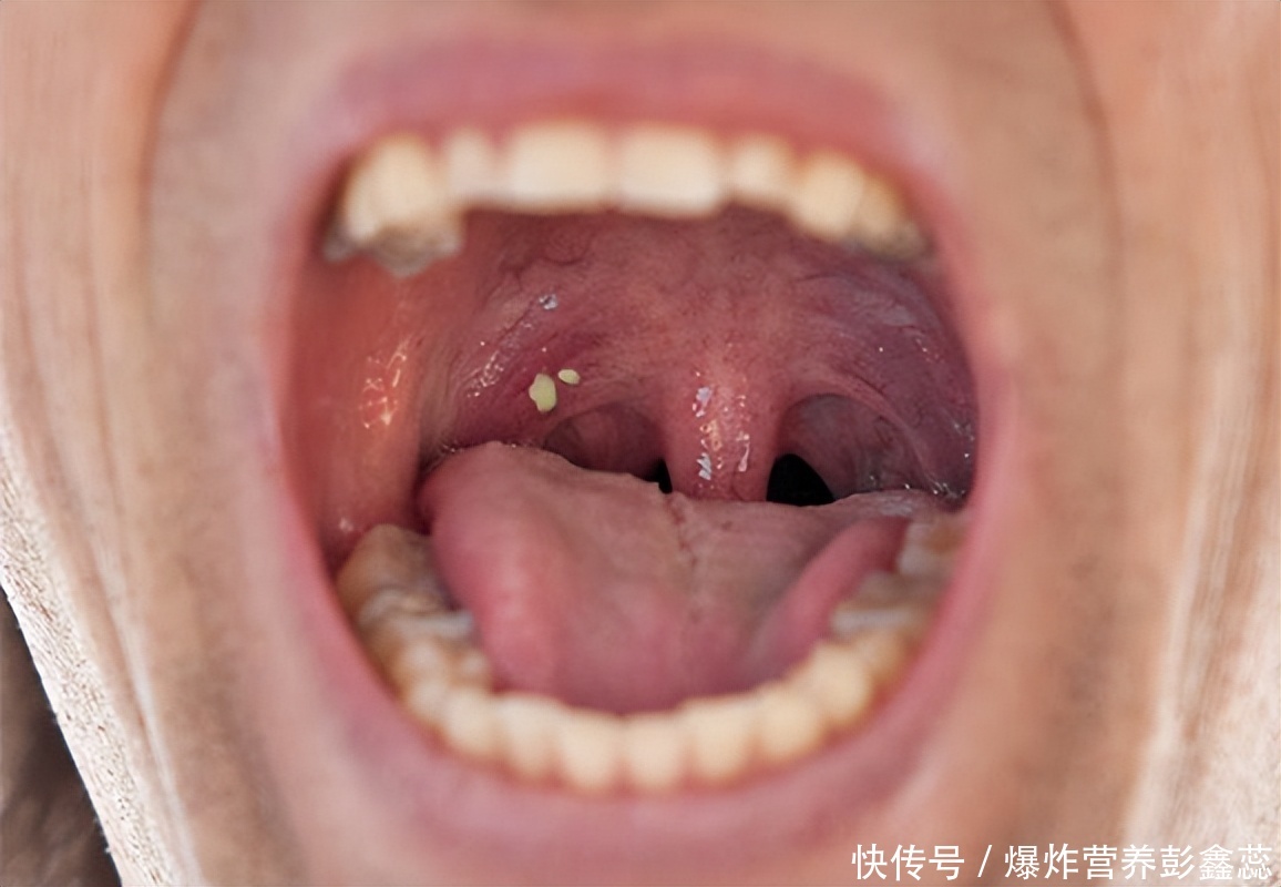 为什么会出现集体咽喉炎？咽喉不适都有哪些原因有关？要重视2023