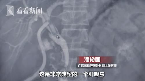  体内|男子体内排出20多条活虫 竟跟常吃这道菜有关！