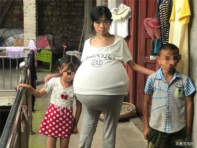  疯长|这到底是什么病？2年时间，她的肚子长得比怀胎十月还大