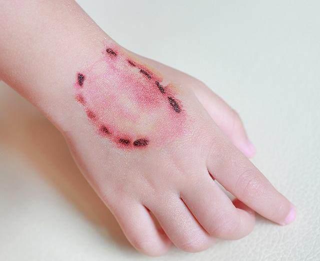  咬伤|怎么办？孩子被宠物咬伤了！