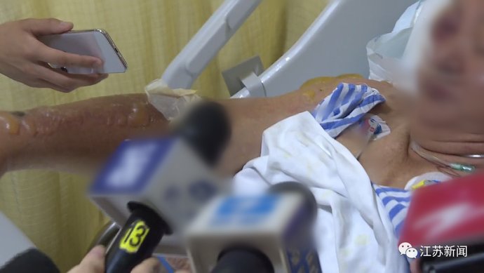  陈大伯|天气有多热？老伯摔了一跤，结果二级烫伤！医生的话让人心惊…