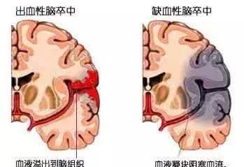 医生|为什么脑梗塞、脑出血容易留下后遗症？医生说和装修房子一个道理