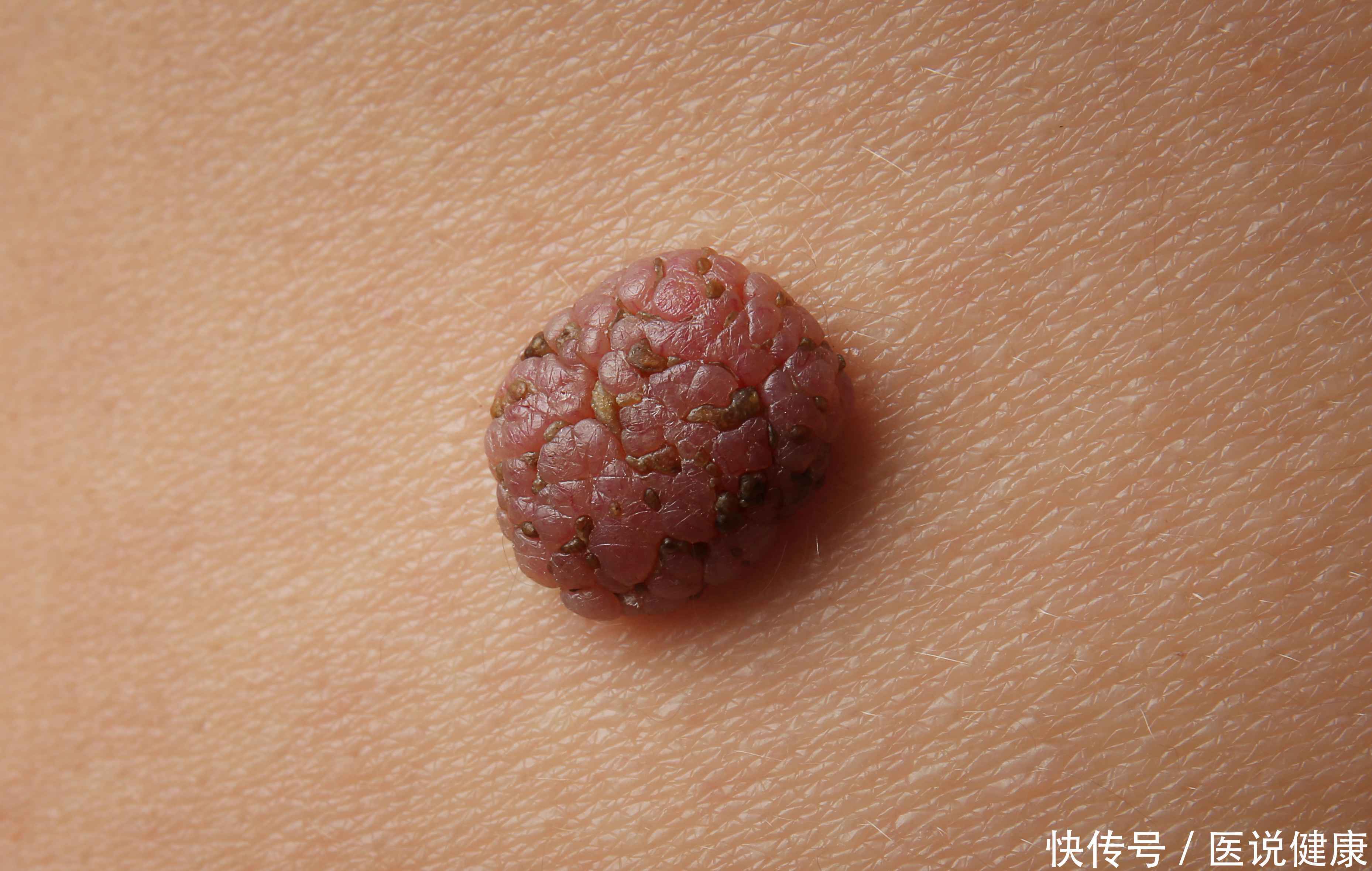 脖子上长小肉疙瘩什么原因引起的(脖子上长小肉疙瘩，别不当回事，这或是这些疾病的征兆！)