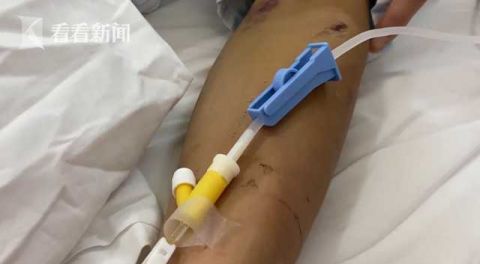 西安市中心医院|近期高发!小伙被它咬一口 脏器受损差点没命