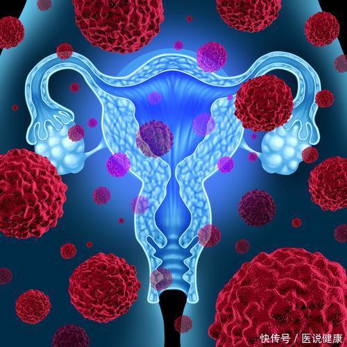 巧克力囊肿跟多囊卵巢有什么区别(巧克力囊肿和多囊卵巢综合症是同种疾病？医生：并不同，一文区分)