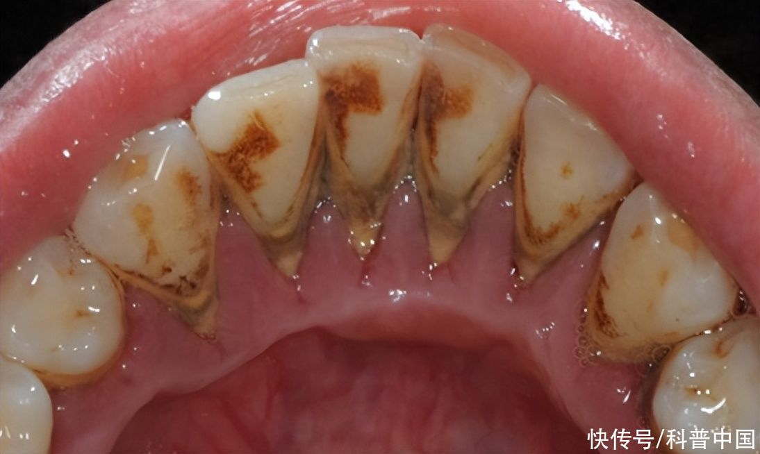 关注牙龈出血和牙齿松动，预防牙周疾病