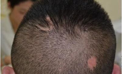  真的|头发移植后真的不会再脱落吗 四点你做好了吗