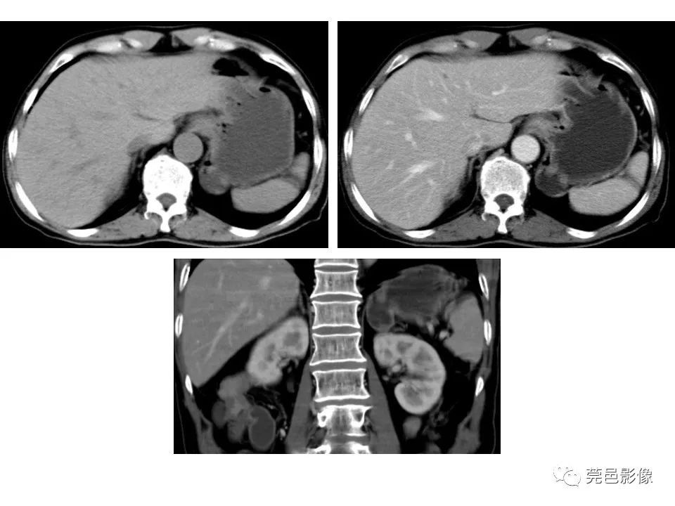 畸形|胃重复畸形CT诊断与鉴别诊断
