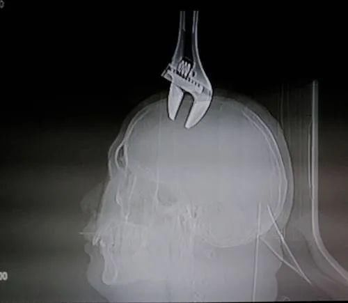  突降|8楼突降扳手，插入路人颅骨2厘米，医生称有一细节救了他