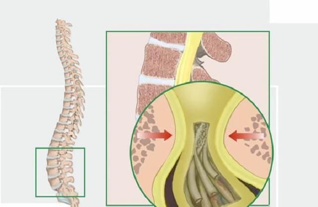  身体|身体出现这3个表现，说明椎管变狭窄了，你却浑然不知！
