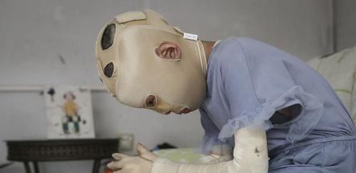  女孩|偷油贼焚车引发车祸致1死2伤，疑犯归案10岁女孩却惨遭毁容