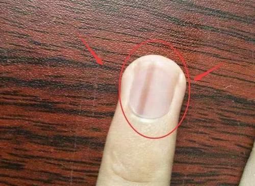 指甲上长出现竖纹可能暗示这几个部位出了问题别大意